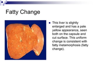 Fatty Change
 This liver is slightly
enlarged and has a pale
yellow appearance, seen
both on the capsule and
cut surface. This uniform
change is consistent with
fatty metamorphosis (fatty
change).
 