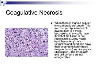 Coagulative Necrosis
 When there is marked cellular
injury, there is cell death. This
microscopic appearance of
myocardium is a mess
because so many cells have
died that the tissue is not
recognizable. Many nuclei
have become pyknotic
(shrunken and dark) and have
then undergone karorrhexis
(fragmentation) and karyolysis
(dissolution). The cytoplasm
and cell borders are not
recognizable.
 
