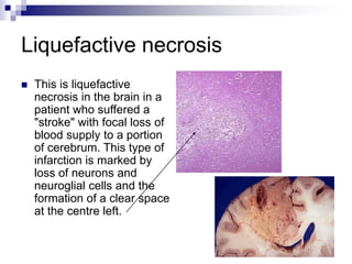 Liquefactive necrosis
 This is liquefactive
necrosis in the brain in a
patient who suffered a
"stroke" with focal loss of
blood supply to a portion
of cerebrum. This type of
infarction is marked by
loss of neurons and
neuroglial cells and the
formation of a clear space
at the centre left.
 