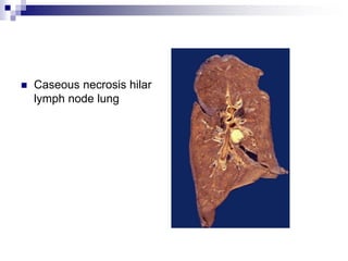  Caseous necrosis hilar
lymph node lung
 