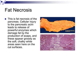 Fat Necrosis
 This is fat necrosis of the
pancreas. Cellular injury
to the pancreatic acini
leads to release of
powerful enzymes which
damage fat by the
production of soaps, and
these appear grossly as
the soft, chalky white
areas seen here on the
cut surfaces.
 