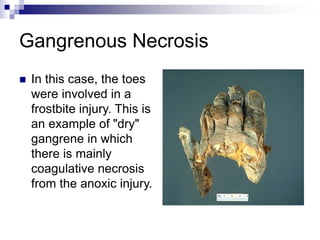 Gangrenous Necrosis
 In this case, the toes
were involved in a
frostbite injury. This is
an example of "dry"
gangrene in which
there is mainly
coagulative necrosis
from the anoxic injury.
 
