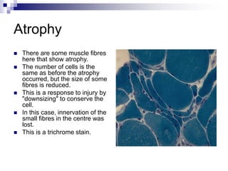Atrophy
 There are some muscle fibres
here that show atrophy.
 The number of cells is the
same as before the atrophy
occurred, but the size of some
fibres is reduced.
 This is a response to injury by
"downsizing" to conserve the
cell.
 In this case, innervation of the
small fibres in the centre was
lost.
 This is a trichrome stain.
 