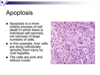 Apoptosis
 Apoptosis is a more
orderly process of cell
death in which there is
individual cell necrosis,
not necrosis of large
numbers of cells.
 In this example, liver cells
are dying individually
(arrows) from injury by
viral hepatitis.
 The cells are pink and
without nuclei.
 
