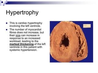 Hypertrophy
 This is cardiac hypertrophy
involving the left ventricle.
 The number of myocardial
fibres does not increase, but
their size can increase in
response to an increased
workload, leading to the
marked thickening of the left
ventricle in this patient with
systemic hypertension.
 