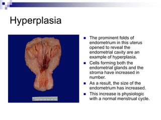 Hyperplasia
 The prominent folds of
endometrium in this uterus
opened to reveal the
endometrial cavity are an
example of hyperplasia.
 Cells forming both the
endometrial glands and the
stroma have increased in
number.
 As a result, the size of the
endometrium has increased.
 This increase is physiologic
with a normal menstrual cycle.
 