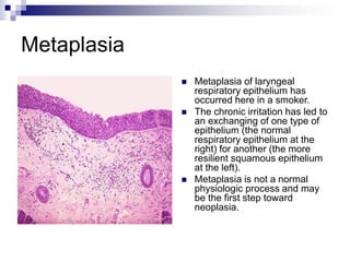 Metaplasia
 Metaplasia of laryngeal
respiratory epithelium has
occurred here in a smoker.
 The chronic irritation has led to
an exchanging of one type of
epithelium (the normal
respiratory epithelium at the
right) for another (the more
resilient squamous epithelium
at the left).
 Metaplasia is not a normal
physiologic process and may
be the first step toward
neoplasia.
 
