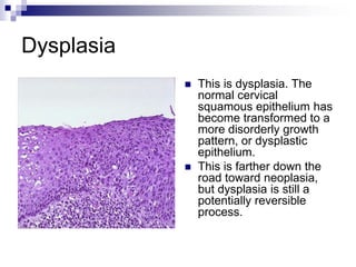 Dysplasia
 This is dysplasia. The
normal cervical
squamous epithelium has
become transformed to a
more disorderly growth
pattern, or dysplastic
epithelium.
 This is farther down the
road toward neoplasia,
but dysplasia is still a
potentially reversible
process.
 