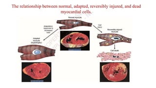 Cell injury death & adaptation