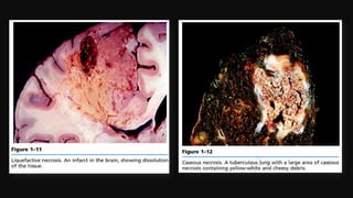 Cell injury death & adaptation