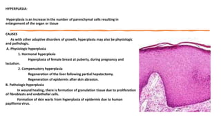 HYPERPLASIA:
Hyperplasia is an increase in the number of parenchymal cells resulting in
enlargement of the organ or tissue...