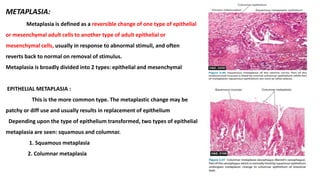 METAPLASIA:
Metaplasia is defined as a reversible change of one type of epithelial
or mesenchymal adult cells to another t...