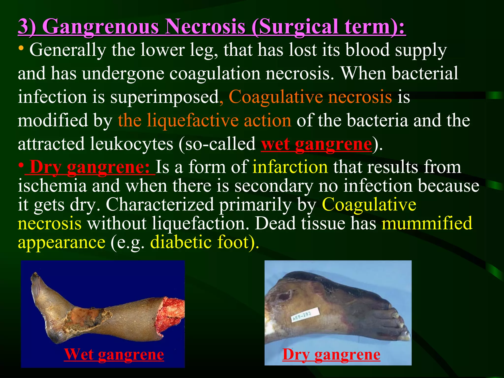 3) Gangrenous Necrosis (Surgical term):
• Generally the lower leg, that has lost its blood supply
and has undergone coagulation necrosis. When bacterial
infection is superimposed, Coagulative necrosis is
modified by the liquefactive action of the bacteria and the
attracted leukocytes (so-called wet gangrene).
• Dry gangrene: Is a form of infarction that results from
ischemia and when there is secondary no infection because
it gets dry. Characterized primarily by Coagulative
necrosis without liquefaction. Dead tissue has mummified
appearance (e.g. diabetic foot).




     Wet gangrene                Dry gangrene
 