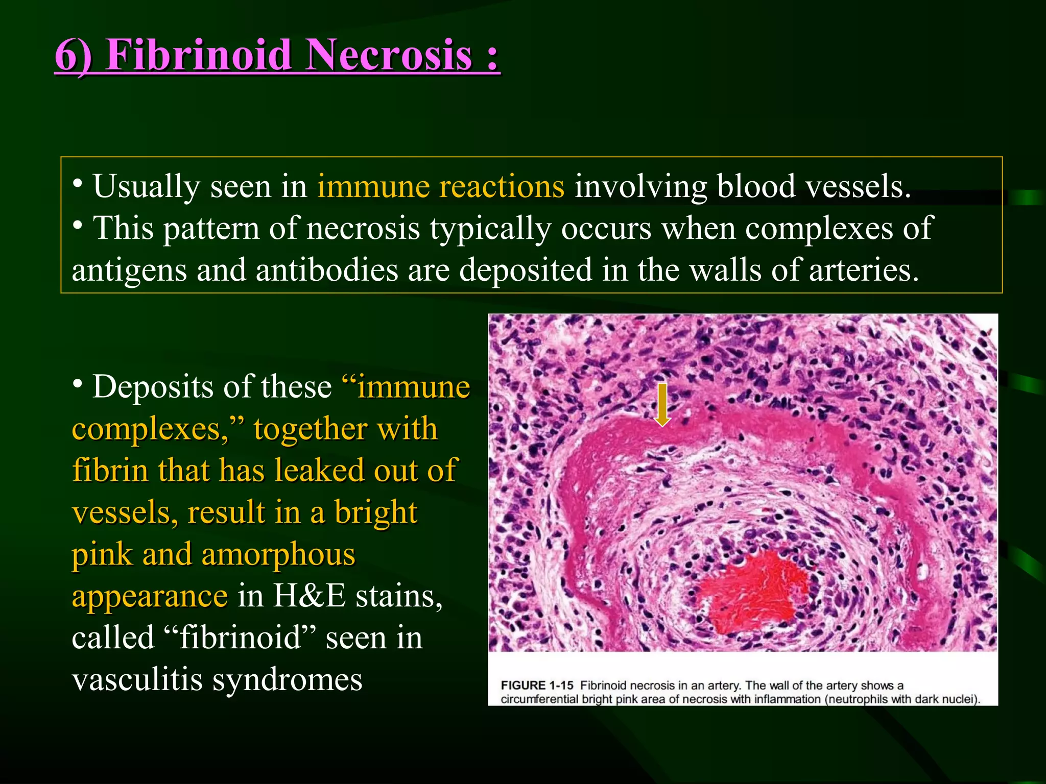6) Fibrinoid Necrosis :

• Usually seen in immune reactions involving blood vessels.
• This pattern of necrosis typically occurs when complexes of
antigens and antibodies are deposited in the walls of arteries.


• Deposits of these “immune
complexes,” together with
fibrin that has leaked out of
vessels, result in a bright
pink and amorphous
appearance in H&E stains,
called “fibrinoid” seen in
vasculitis syndromes
 