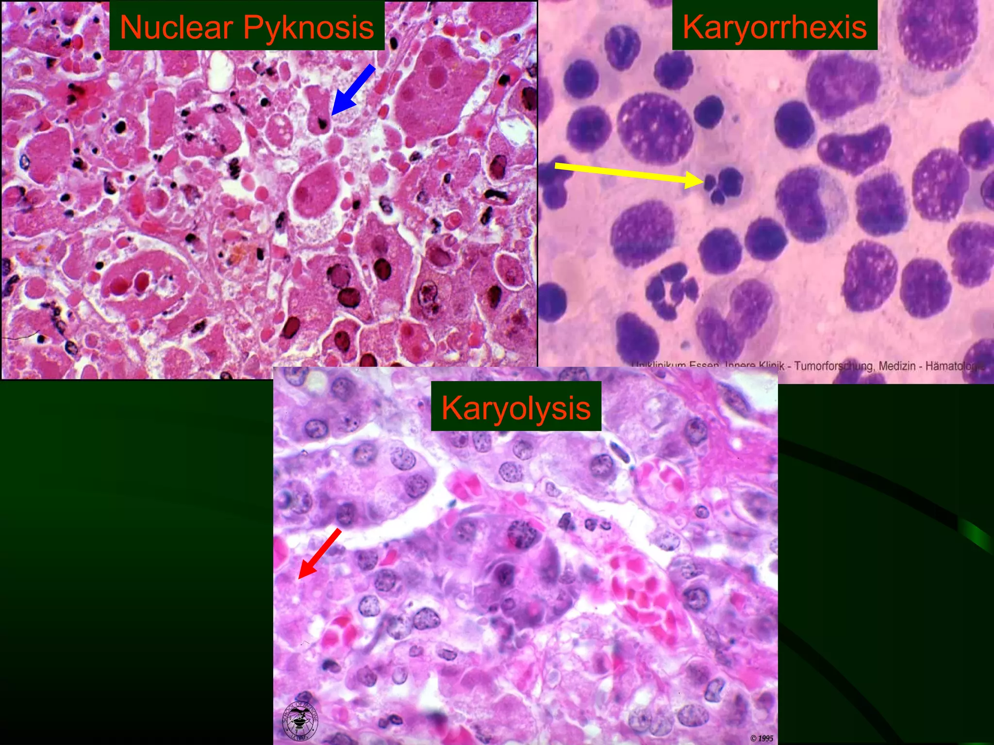 Nuclear Pyknosis                Karyorrhexis




                   Karyolysis
 