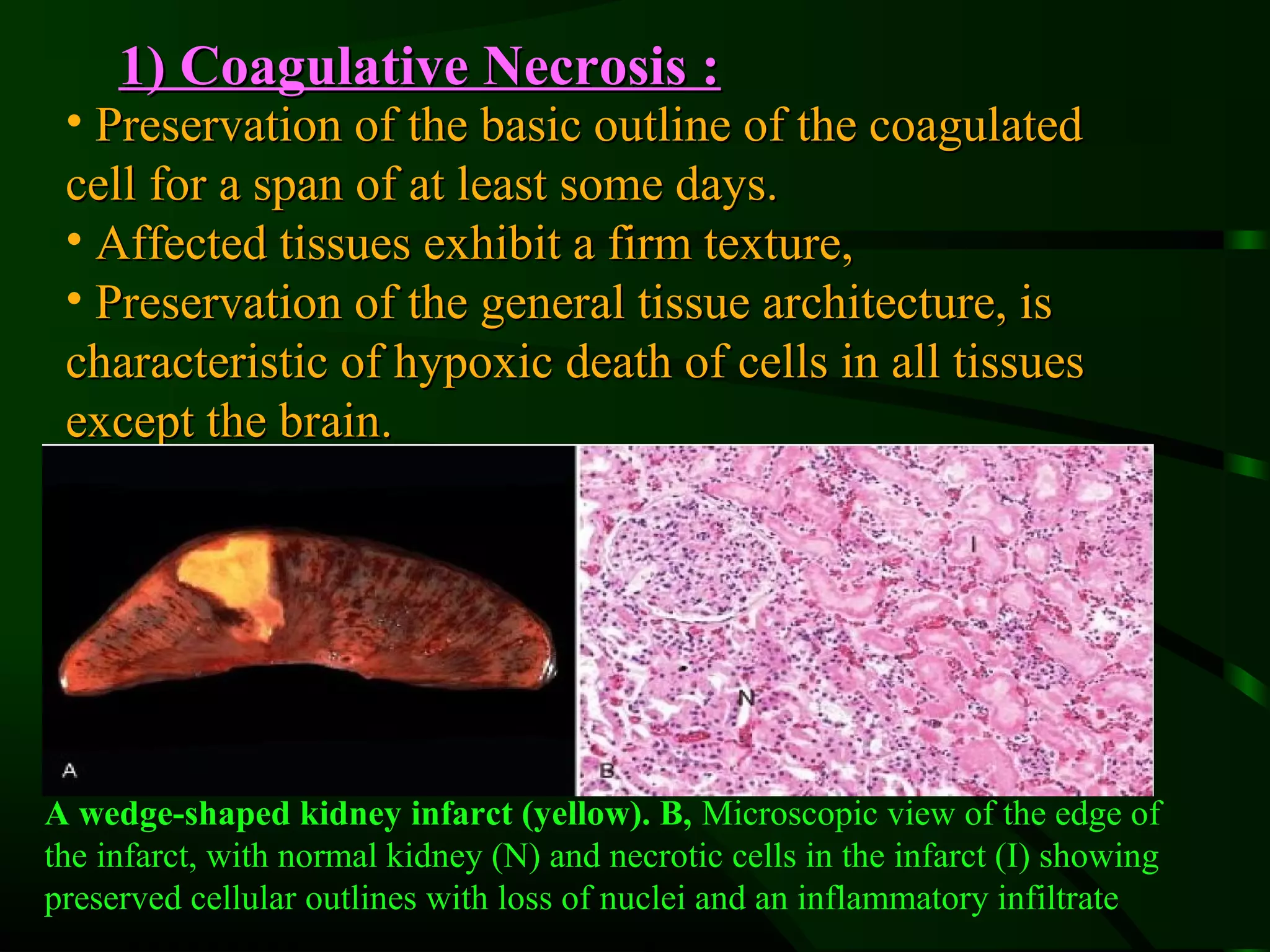 1) Coagulative Necrosis :
 • Preservation of the basic outline of the coagulated
 cell for a span of at least some days.
 • Affected tissues exhibit a firm texture,
 • Preservation of the general tissue architecture, is
 characteristic of hypoxic death of cells in all tissues
 except the brain.




A wedge-shaped kidney infarct (yellow). B, Microscopic view of the edge of
the infarct, with normal kidney (N) and necrotic cells in the infarct (I) showing
preserved cellular outlines with loss of nuclei and an inflammatory infiltrate
 