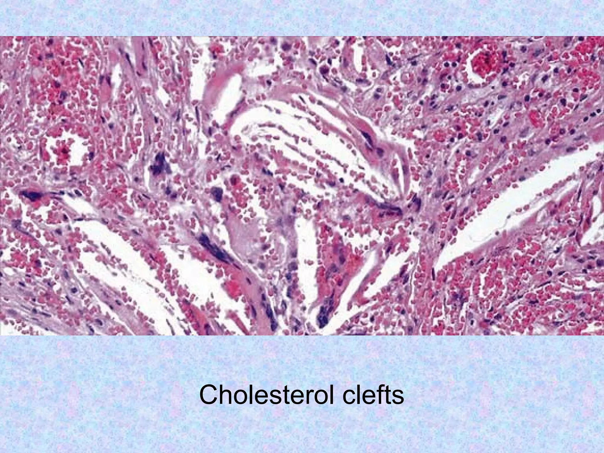 Cholesterol clefts
 