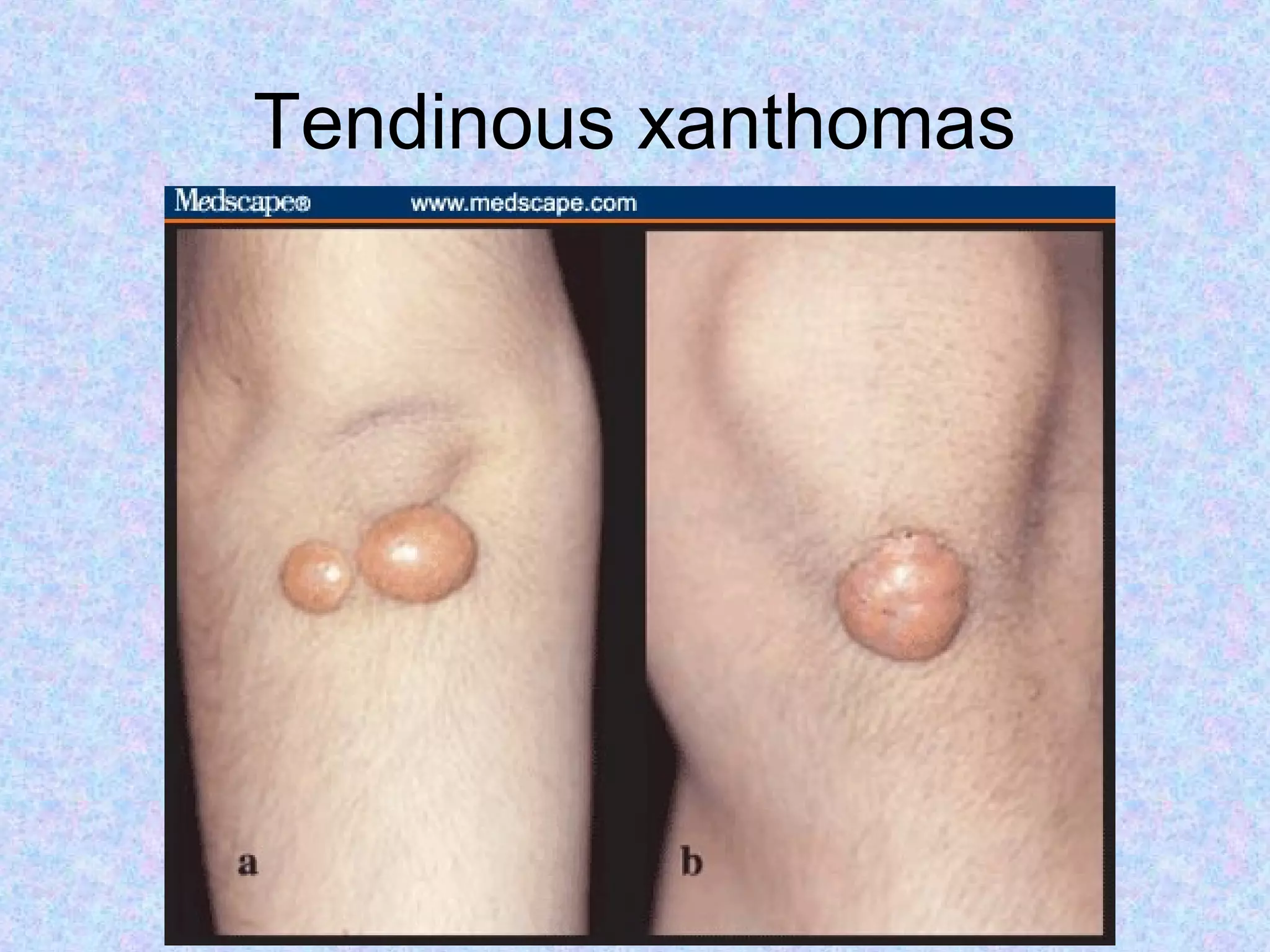 Tendinous xanthomas
 