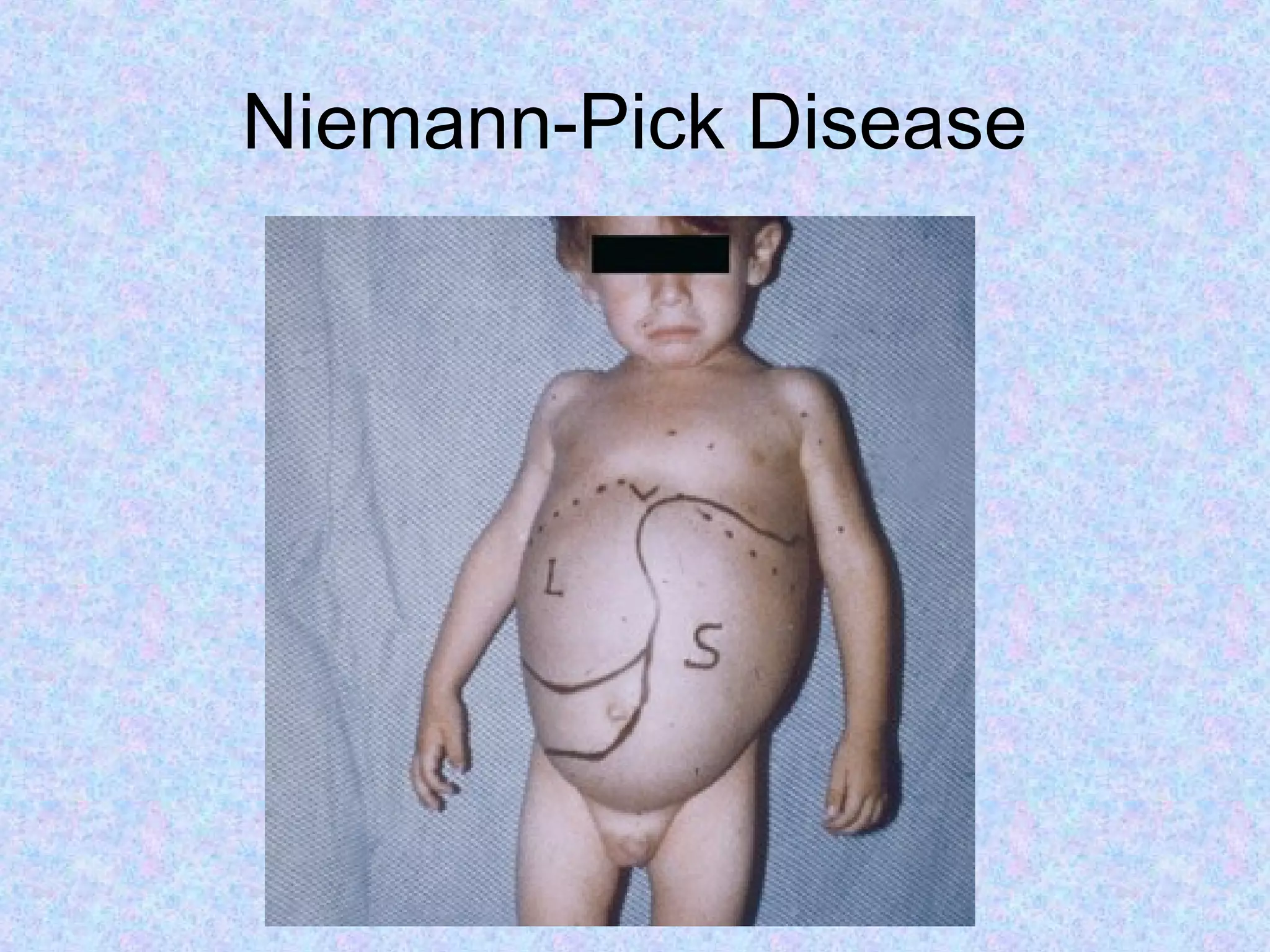 Niemann-Pick Disease
 