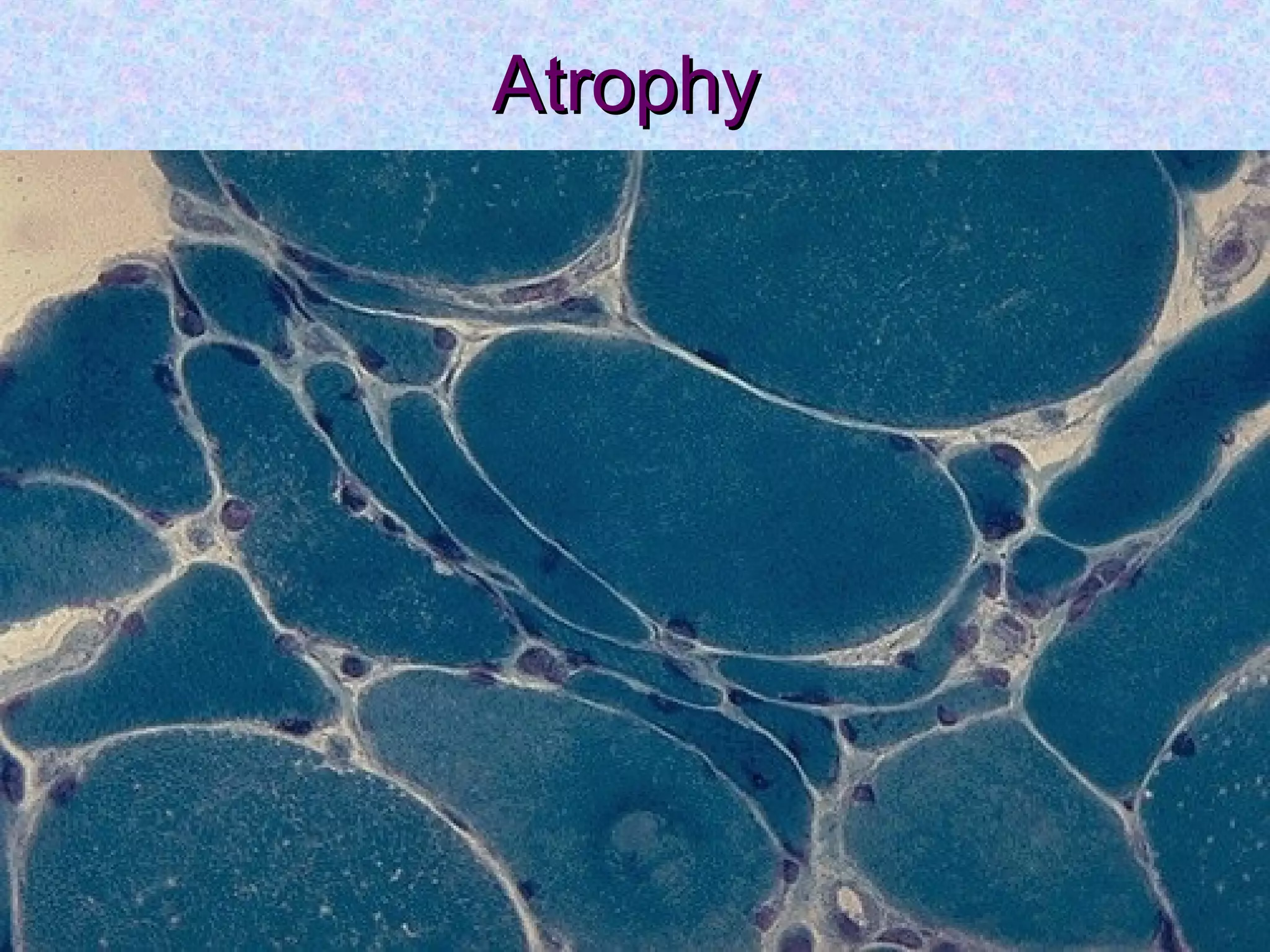 AtrophyAtrophy
 