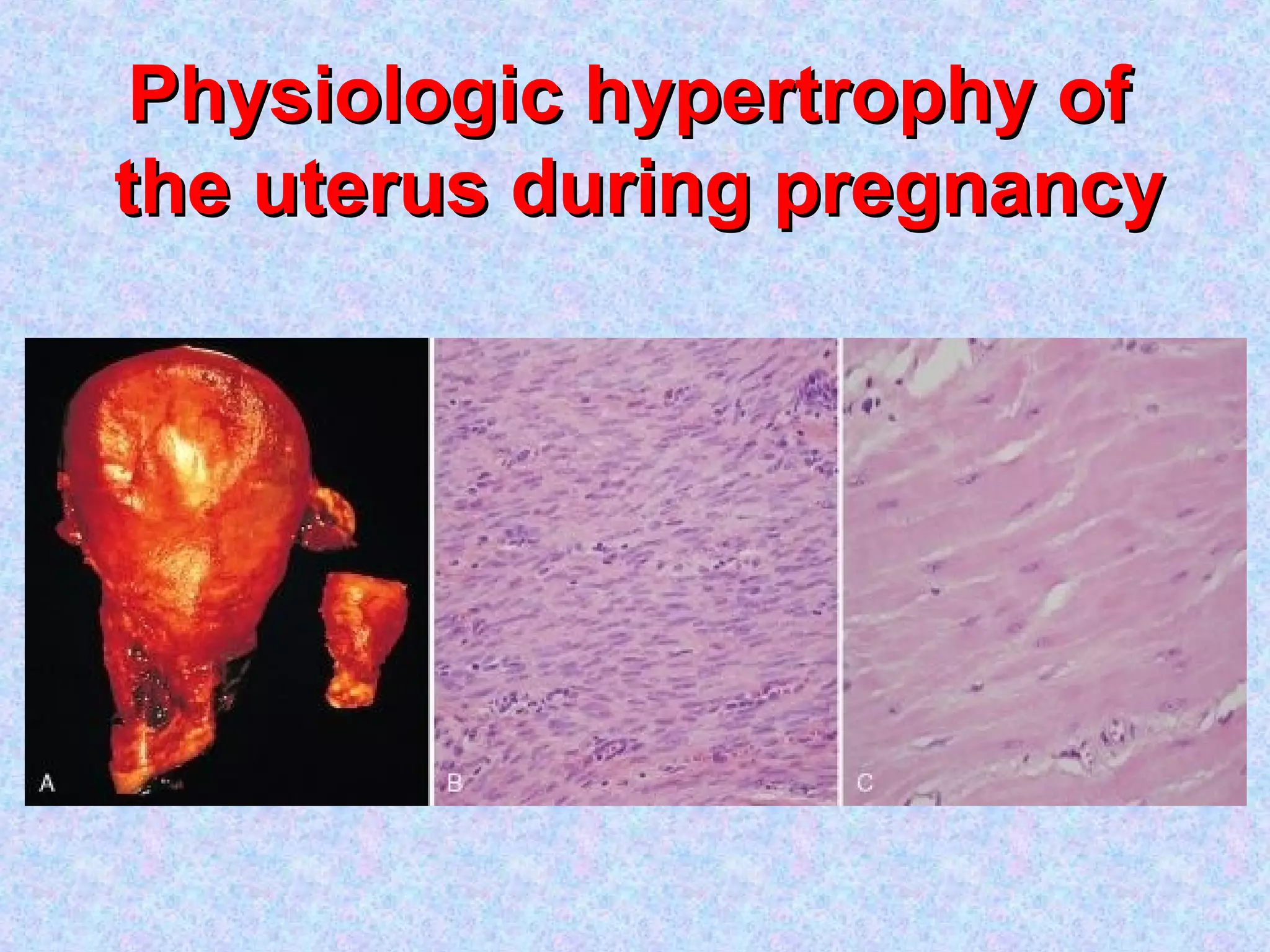 Physiologic hypertrophy ofPhysiologic hypertrophy of
the uterus during pregnancythe uterus during pregnancy
 
