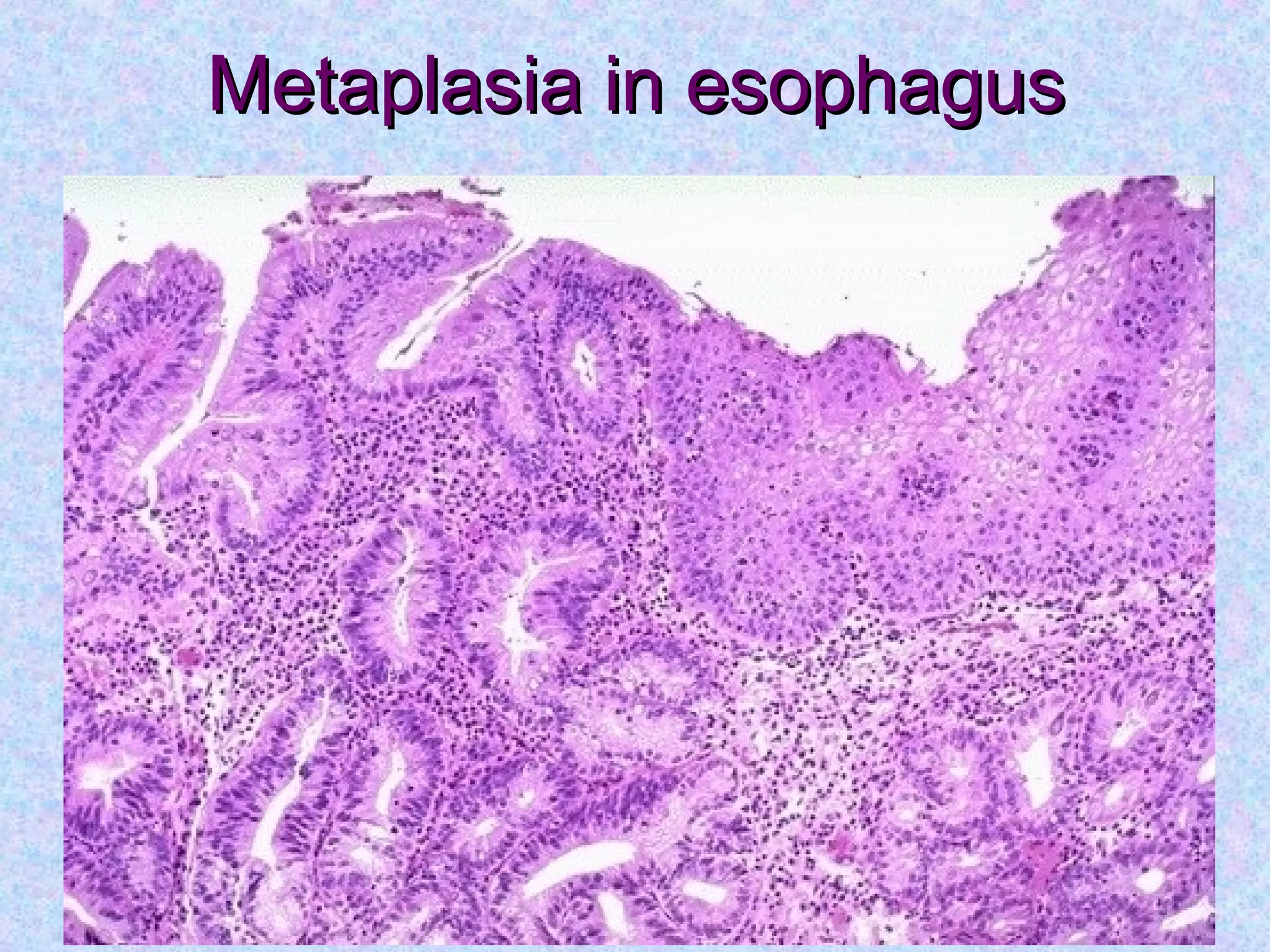 Metaplasia in esophagusMetaplasia in esophagus
 