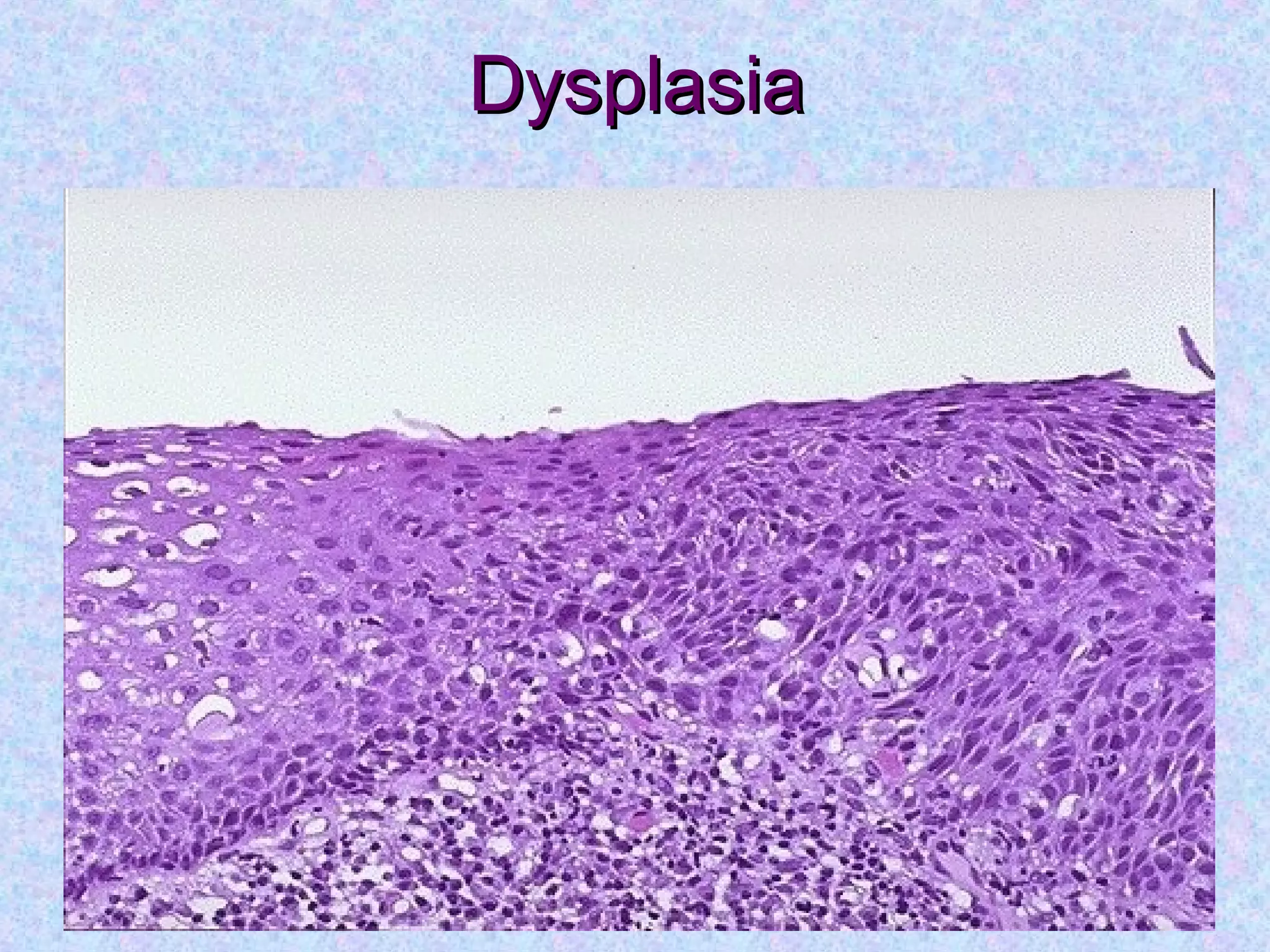 DysplasiaDysplasia
 