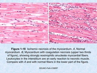 SDUMC-Path-CSBRP
Figure 1-18 Ischemic necrosis of the myocardium. A, Normal
myocardium. B, Myocardium with coagulation necrosis (upper two thirds
of figure), showing strongly eosinophilic anucleate myocardial fibers.
Leukocytes in the interstitium are an early reaction to necrotic muscle.
Compare with A and with normal fibers in the lower part of the figure.
 
