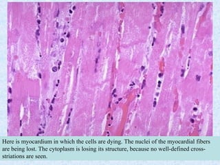 SDUMC-Path-CSBRP
Here is myocardium in which the cells are dying. The nuclei of the myocardial fibers
are being lost. The cytoplasm is losing its structure, because no well-defined cross-
striations are seen.
 