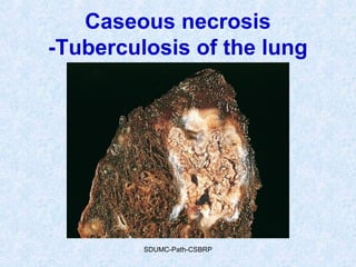 Caseous necrosis
-Tuberculosis of the lung
SDUMC-Path-CSBRP
 
