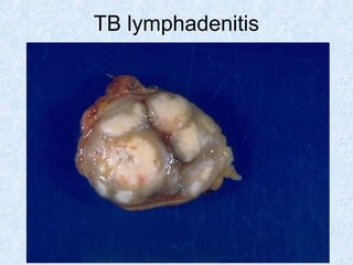 SDUMC-Path-CSBRP
TB lymphadenitis
 