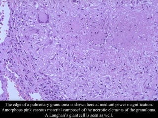 SDUMC-Path-CSBRP
The edge of a pulmonary granuloma is shown here at medium power magnification.
Amorphous pink caseous material composed of the necrotic elements of the granuloma.
A Langhan’s giant cell is seen as well.
 