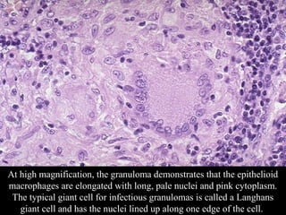SDUMC-Path-CSBRP
At high magnification, the granuloma demonstrates that the epithelioid
macrophages are elongated with long, pale nuclei and pink cytoplasm.
The typical giant cell for infectious granulomas is called a Langhans
giant cell and has the nuclei lined up along one edge of the cell.
 