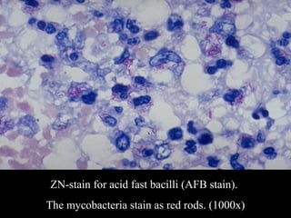 SDUMC-Path-CSBRP
ZN-stain for acid fast bacilli (AFB stain).
The mycobacteria stain as red rods. (1000x)
 