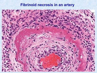 SDUMC-Path-CSBRP
Fibrinoid necrosis in an artery
 