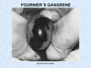 SDUMC-Path-CSBRP
FOURNIER´S GANGRENE
 