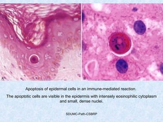 SDUMC-Path-CSBRP
Apoptosis of epidermal cells in an immune-mediated reaction.
The apoptotic cells are visible in the epidermis with intensely eosinophilic cytoplasm
and small, dense nuclei.
 