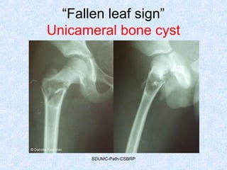 “Fallen leaf sign”
Unicameral bone cyst
SDUMC-Path-CSBRP
 