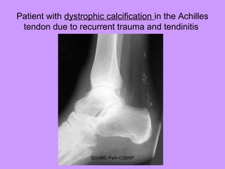 Patient with dystrophic calcification in the Achilles
tendon due to recurrent trauma and tendinitis
SDUMC-Path-CSBRP
 