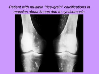 Patient with multiple "rice-grain" calcifications in
muscles about knees due to cysticercosis
SDUMC-Path-CSBRP
 