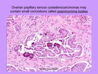 Ovarian papillary serous cystadenocarcinomas may
contain small concretions called psammomma bodies
SDUMC-Path-CSBRP
 