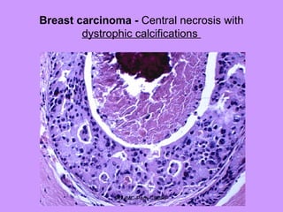 Breast carcinoma - Central necrosis with
dystrophic calcifications
SDUMC-Path-CSBRP
 