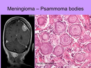 Meningioma – Psammoma bodies
SDUMC-Path-CSBRP
 