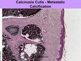 Calcinosis Cutis - Metastatic
Calcification
SDUMC-Path-CSBRP
 