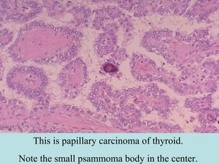 This is papillary carcinoma of thyroid.
Note the small psammoma body in the center.
 