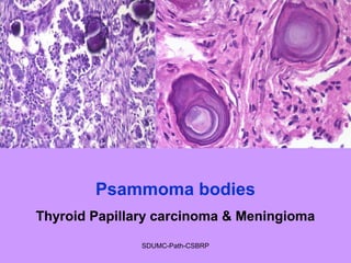 Psammoma bodies
Thyroid Papillary carcinoma & Meningioma
SDUMC-Path-CSBRP
 