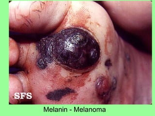 Melanin - Melanoma
 