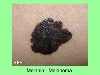 Melanin - Melanoma
 