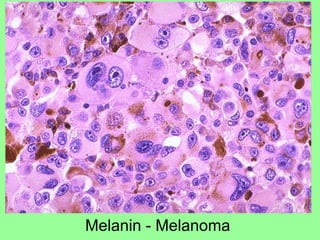 Melanin - Melanoma
 