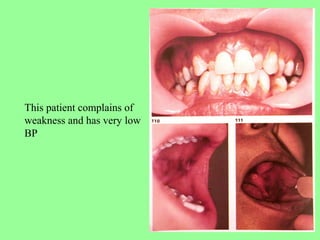This patient complains of
weakness and has very low
BP
 